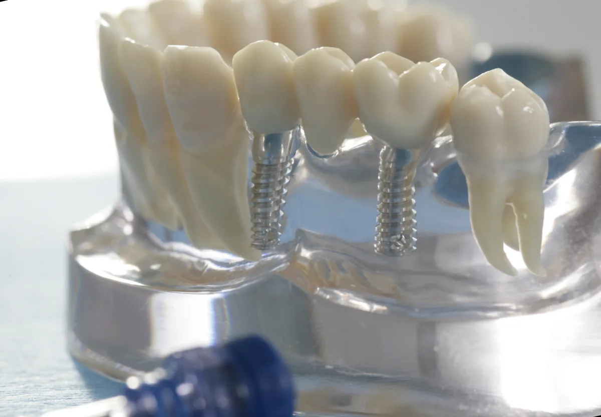 Zahnmodell mit Implantaten